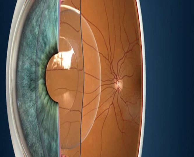 کاربردهای لنز دائمی چیست؟